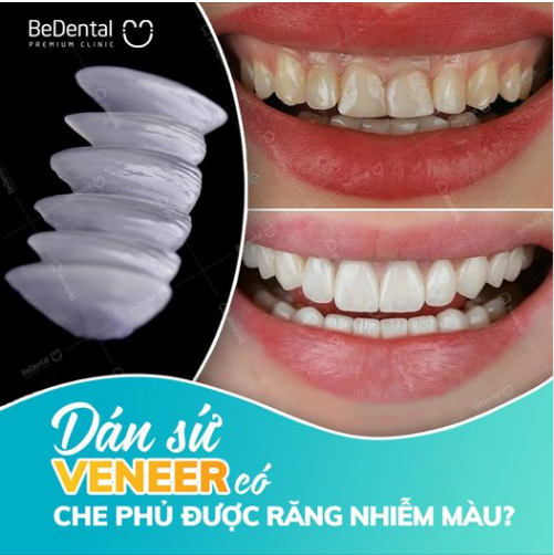 Dán sứ Vener có che phủ được răng nhiễm màu?