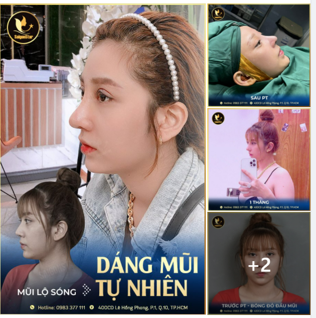 ĐÁNH BAY MŨI LỘ SÓNG - SẮM NGAY DÁNG MŨI TỰ NHIÊN