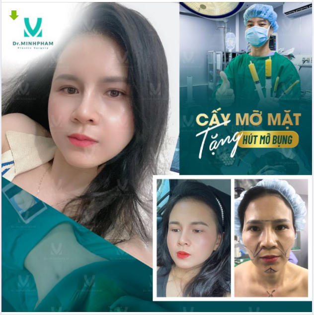 ĐẢO NGƯỢC LÃO HÓA – XÓA TAN MỠ BỤNG ĐẸP HOÀN HẢO VỚI COMBO CẤY MỠ MẶT TẶNG HÚT MỠ BỤNG