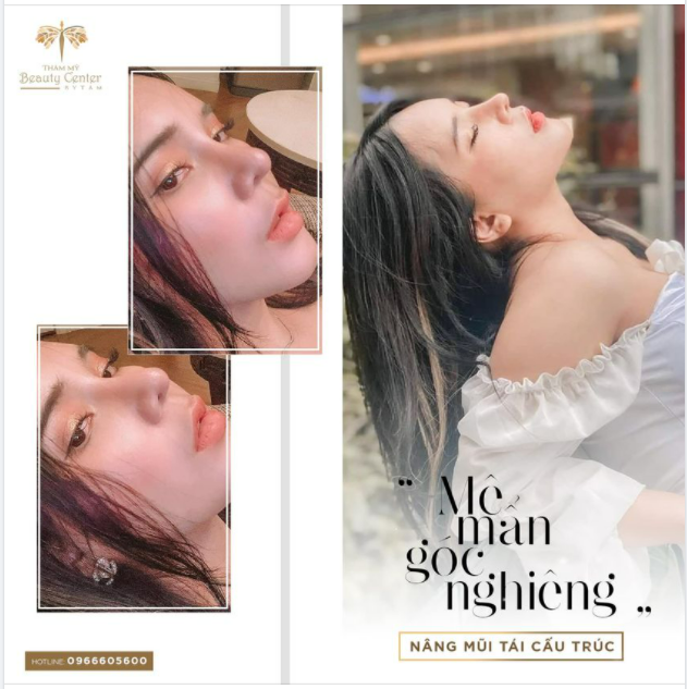 Đầu mũi to bè, muốn nhỏ gọn?  Mũi thấp tẹt, không có sóng, muốn trở nên cao tây?