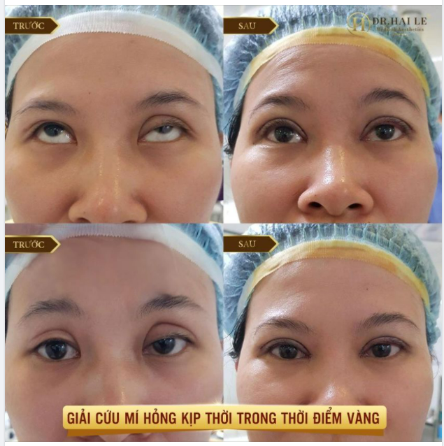 ĐAU NHỨC MỎI MÍ MẮT TRỢN, KHÔNG THỂ NHẮM ĐƯỢC TOÀN BỘ MẮT CHỈ SAU 10 NGÀY THẨM MỸ TẠI CƠ SỞ KHÁC...