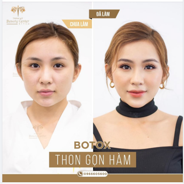ĐÂY LÀ KẾT QUẢ CỦA BOTOX THON GỌN HÀM TẠI Tấm