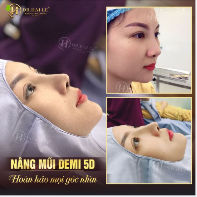 Để sở hữu kết quả mũi đẹp và an toàn phải dựa vào các yếu tố nào?
