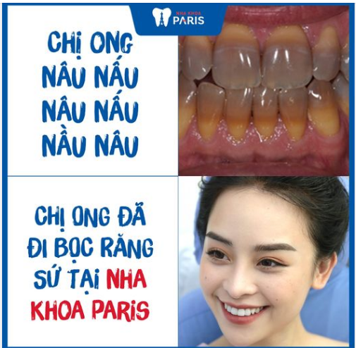 Đến ngay Nha khoa Paris để trải nghiệm dịch vụ làm răng sứ, lấy lại nụ cười tự tin, trắng sáng, tạm biệt hàm răng nâu xỉn màu!