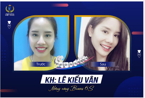 Đến với Nha khoa Quốc tế Việt Đức thăm khám và tư vấn, Kiều Vân quyết định lựa chọn niềng răng mắc cài Titan