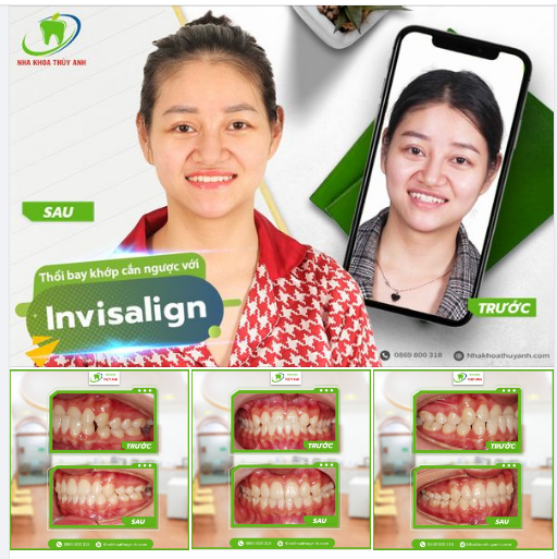ĐẸP MỖI NGÀY CÙNG NIỀNG RĂNG KHÔNG MẮC CÀI INVISALIGN