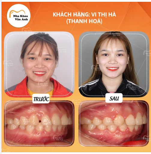 ĐIỂM DANH NHỮNG LỢI ÍCH CỦA  NIỀNG RĂNG ?