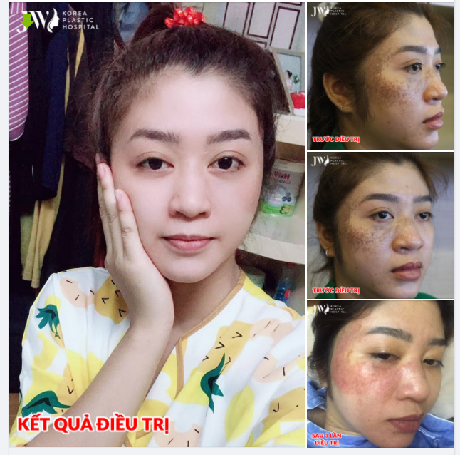 Điều trị BỚT BẨM SINH kéo CHỊ GÁI BẾN TRE thoát "VỰC THẲM TĂM TỐI"