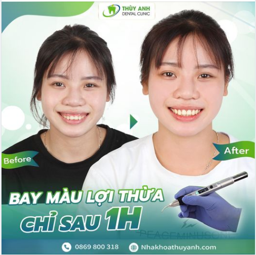 ĐIỀU TRỊ CƯỜI HỞ LỢI CHỈ MỘT LẦN DUY NHẤT CƯỜI ĐẸP MÃI VỀ SAU