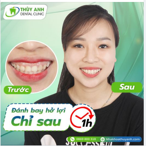 ĐIỀU TRỊ CƯỜI HỞ LỢI - THẨM MỸ NỤ CƯỜI AN TOÀN - HIỆU QUẢ