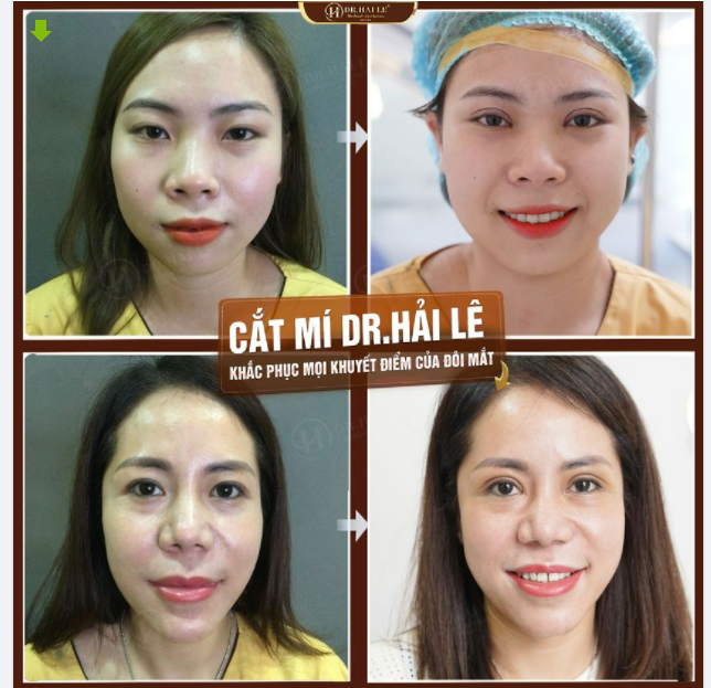 Đôi mắt đẹp của khách hàng là niềm vui của Dr.Hải Lê.!