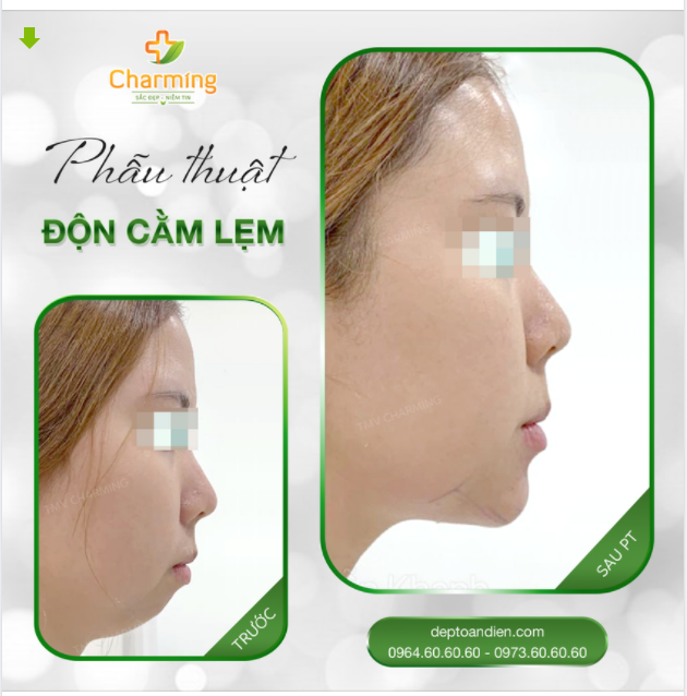 ĐỘN CẰM LẸM, ĐEM VẺ HÀI HÒA VỀ TRÊN KHUÔN MẶT