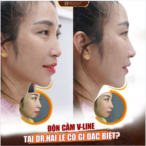 ĐỘN CẰM V-LINE TẠI DR.HẢI LÊ CÓ GÌ ĐẶC BIỆT?