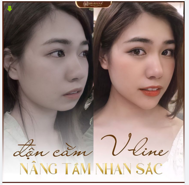 Độn cằm V-line tại Dr.Hải Lê - Nâng tầm nhan sắc.!
