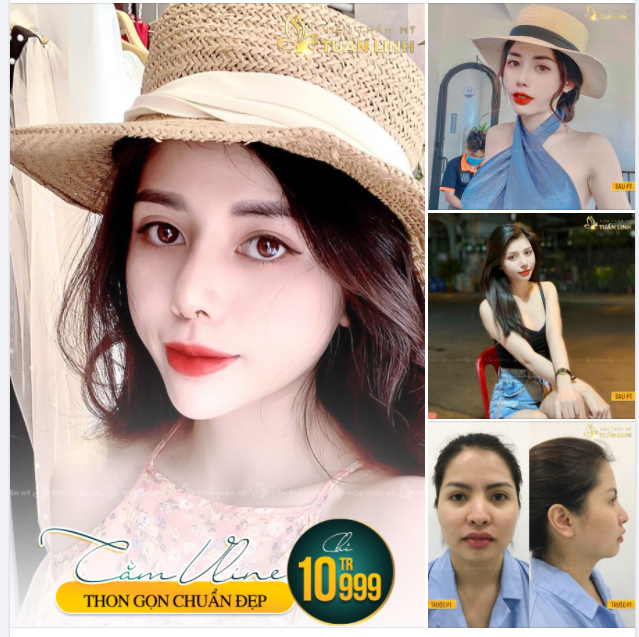 ĐỘN CẰM VLINE - GIẢI PHÁP TỐI ƯU GIÚP KHẮC PHỤC CẰM LẸM, NGẮN.