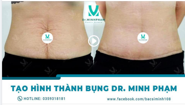 DỌN DẸP DA TRÙNG – THỔI BÙNG TỰ TIN FEEDBACK THỰC TẾ TRƯỚC VÀ SAU TẠO HÌNH THÀNH BỤNG