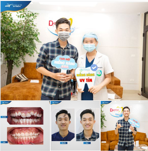 ĐÓN NỤ CƯỜI MỚI SAU 13 THÁNG NIỀNG RĂNG "MÓM" TẠI NHA KHOA LẠC VIỆT INETCH