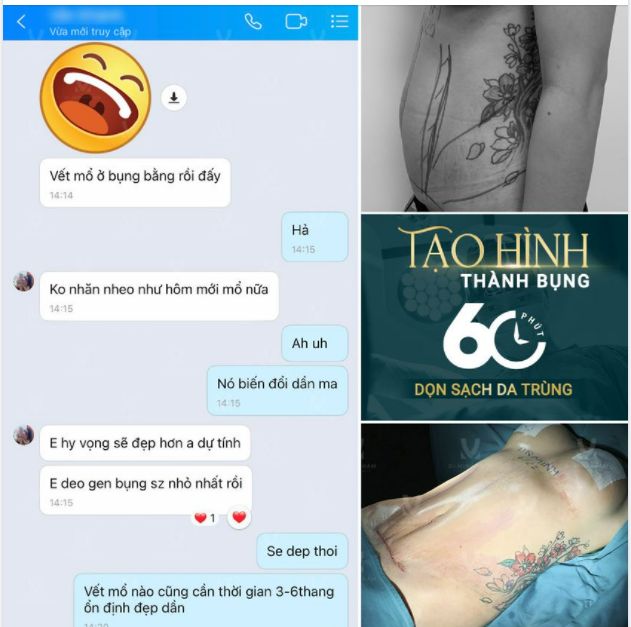 DỌN SẠCH DA TRÙNG – TẠO HÌNH THÀNH BỤNG