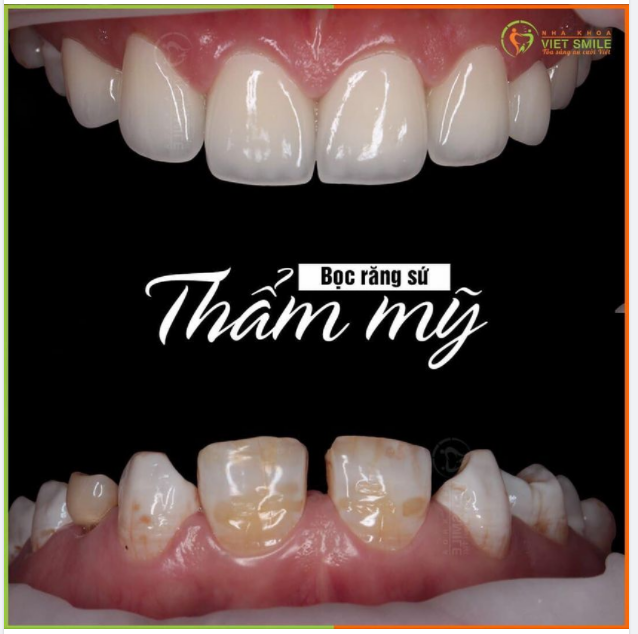 ĐÓNG CỬA RĂNG THƯA VỚI PHƯƠNG PHÁP BỌC SỨ THẨM MỸ