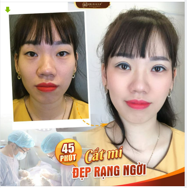 Dr.Hải Lê, CẮT MÍ quá đẹp”
