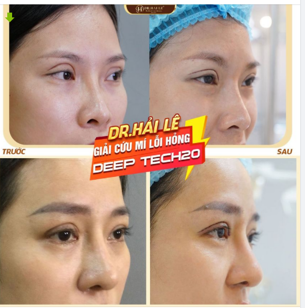 DR.HẢI LÊ - CƠ SỞ THẨM MỸ UY TÍN - Yếu tố tiên quyết cho thành công của 1 ca giải cứu mí lỗi, hỏng