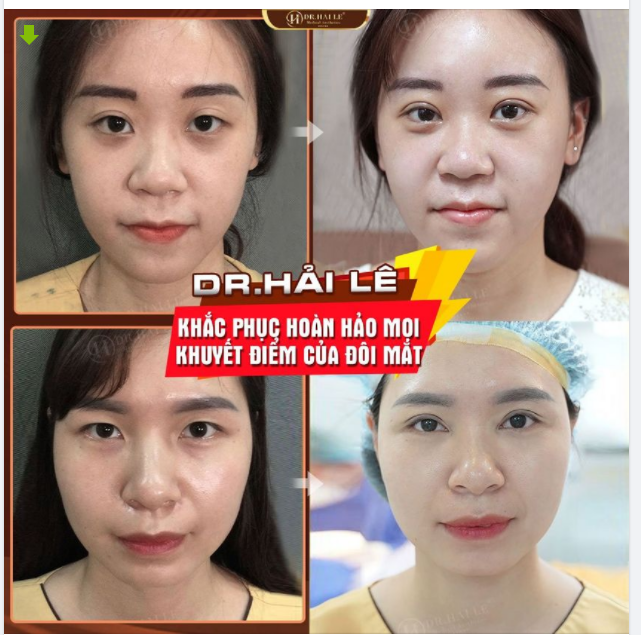 DR.HẢI LÊ - KHẮC PHỤC HOÀN HẢO MỌI KHUYẾT ĐIỂM CỦA ĐÔI MẮT.!!!