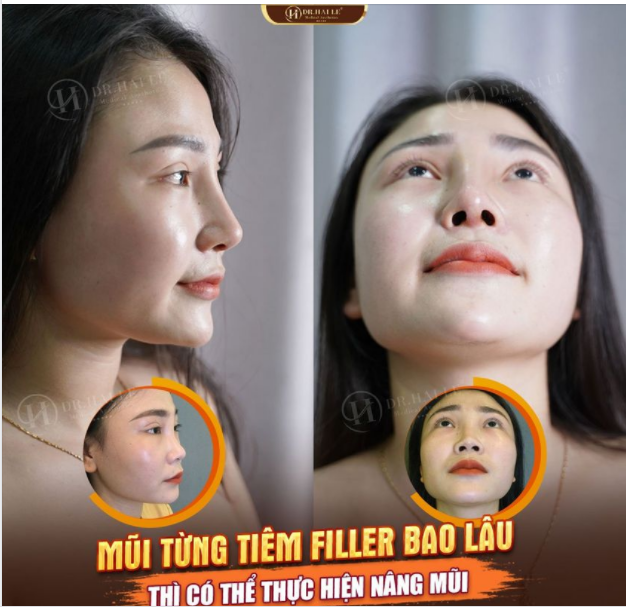 DR.HẢI LÊ TƯ VẤN: Mũi đã từng tiêm Filler, bao lâu có thể nâng mũi được và sau khi nâng có đẹp tự nhiên như mũi thường không ?