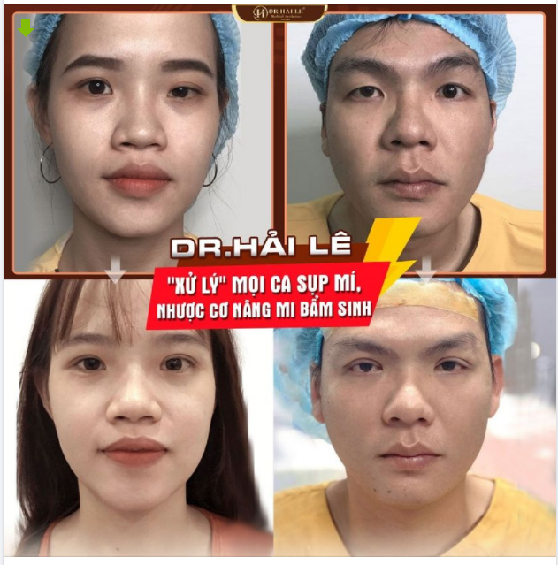 DR.HẢI LÊ - "XỬ LÝ" HOÀN HẢO MỌI CA SỤP MÍ, NHƯỢC CƠ NÂNG MI BẨM SINH