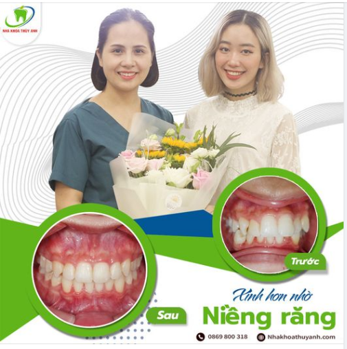 ĐỪNG ĐỂ QUÁ MUỘN MỚI THỰC HIỆN NIỀNG RĂNG