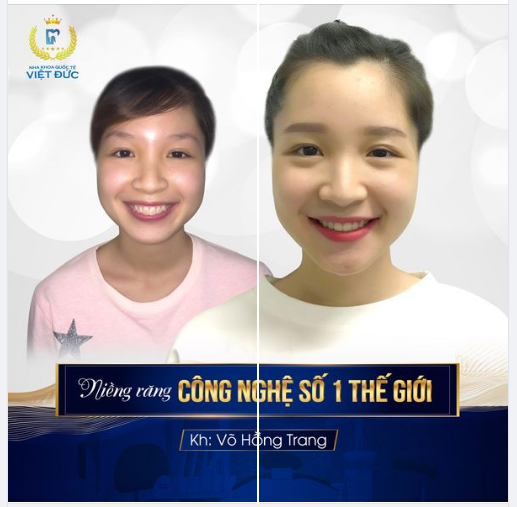 Được bạn bè giới thiệu, Hồng Trang đã đến nha khoa Quốc tế Việt Đức để khắc phục nhược điểm. Sở hữu hàm răng đều, nụ cười rạng rỡ.