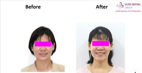 Elite Dental mời bạn cùng nhìn lại hành trình Invisalign của chị L.Q.T 36 tuổi ngụ tại TP.HCM.