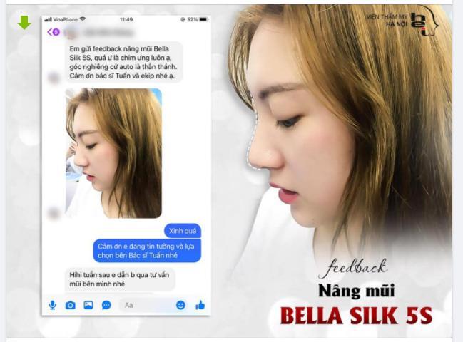 "" Em gửi feedback nâng mũi Bella Silk 5S, quá ư là chim ưng luôn ạ, góc nghiêng cứ auto là thần thánh. Cảm ơn bác sĩ Tuấn và ekip nhé ạ.""