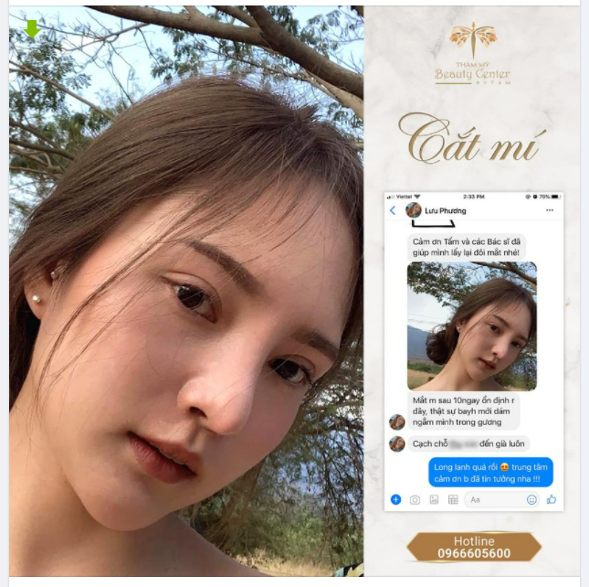 Feedback cuối tuần đầy ngọt ngào của khách hàng Cắt mí Line Mini tại Tấm.