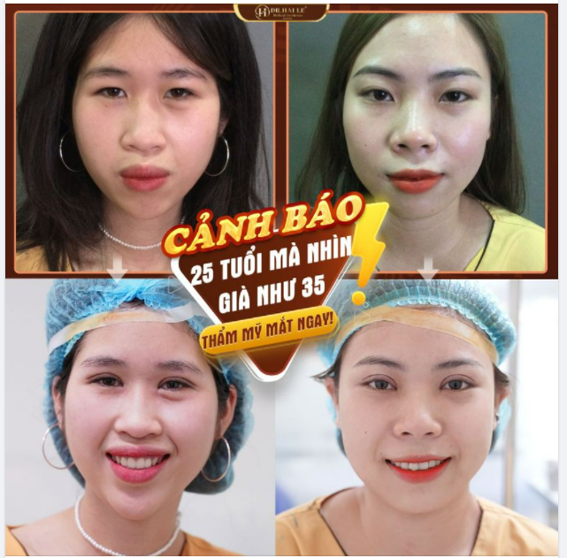 FEEDBACK kết quả cắt mí sau khi thực hiện và sau 7 ngày của 2 bạn khách hàng - Đẹp ngay từ cái nhìn đầu tiên...