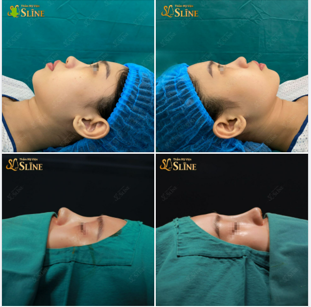 FEEDBACK "Nâng mũi Sline - đẹp ngay sau 45p"