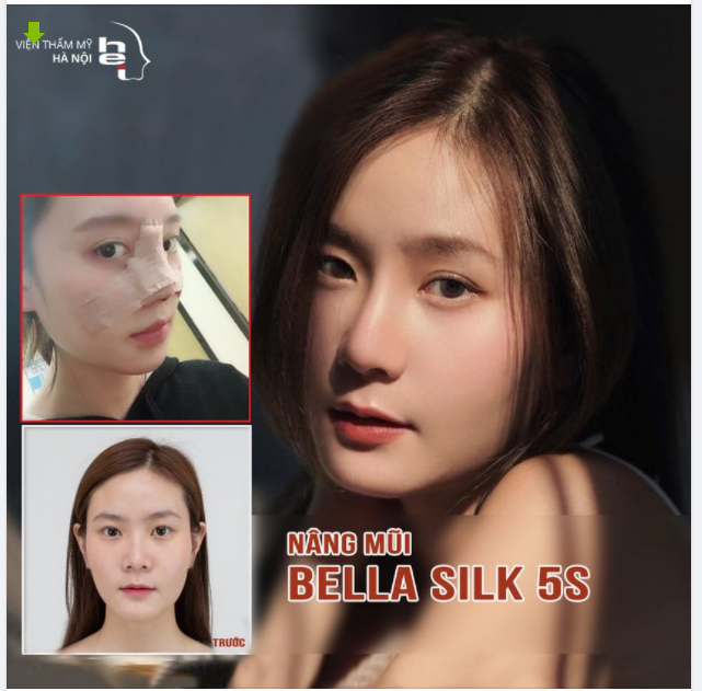 FeedBack từ khách hàng sau khi thực hiện nâng mũi tại Viện thẩm mỹ Hà Nội – trực tiếp từ Ts.Bs Mai Mạnh Tuấn – 30 năm kinh nghiệm trong nghành thẩm mỹ làm đẹp.