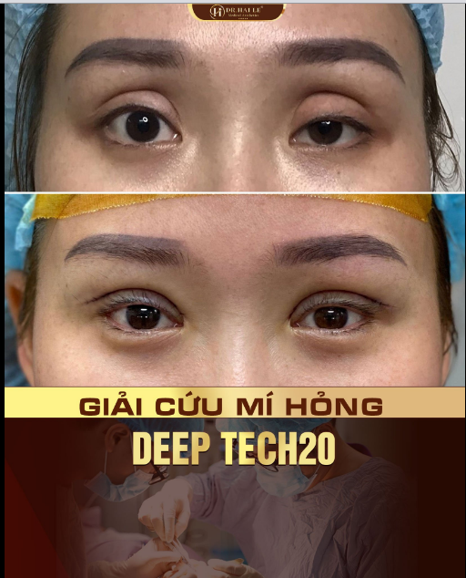 "GẤP" : GIẢI CỨU MÍ LỖI HỎNG SẸO DÀY GẤP RƯỠI!