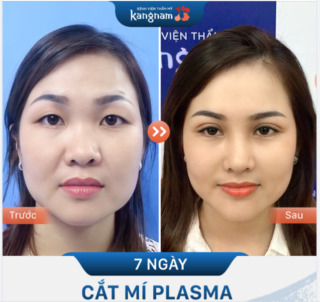 Gặp lại chị gái sau 7 ngày CẮT MÍ PLASMA.............