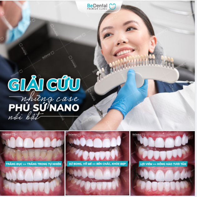 "Giải cứu" các case phủ sứ nano tại nha khoa Bedental
