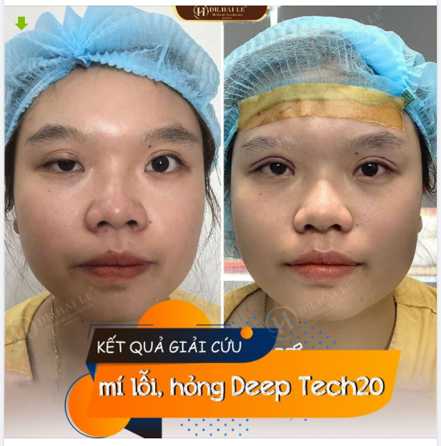 GIẢI CỨU MÍ HỎNG DEEP TECH20 Xem hình ảnh để cảm nhận kết quả!