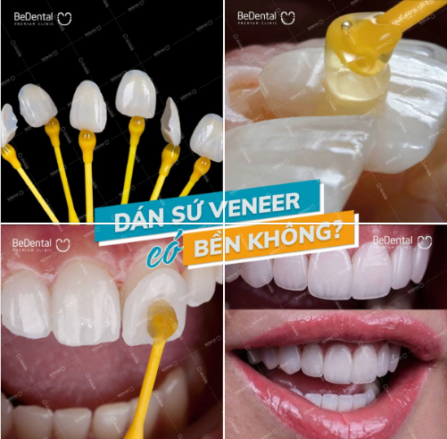 GIẢI ĐÁP BĂN KHOĂN DÁN SỨ VENEER CÓ BỀN KHÔNG?