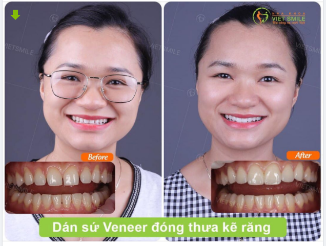 Giải pháp "đóng cửa" khe thưa bằng phương pháp dán sứ Veneer.