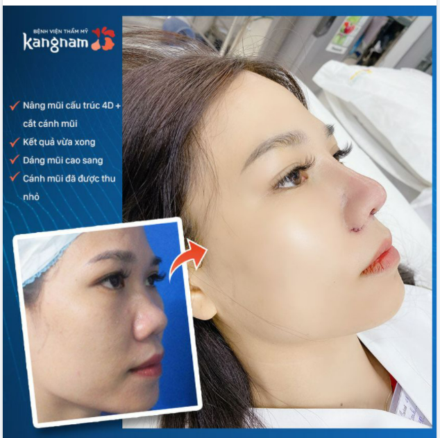 Góc biến hình mũi tẹt thành mũi mũi S-line siêu tự nhiên khi vừa làm xong