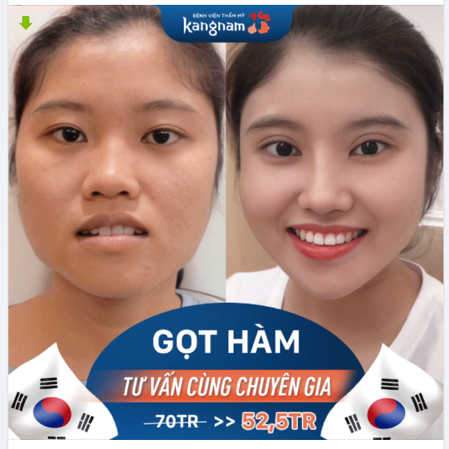 Gửi ĐỘNG LỰC cho chị em đang sở hữu những chiếc Hàm thô/ vuông/ bạnh nè