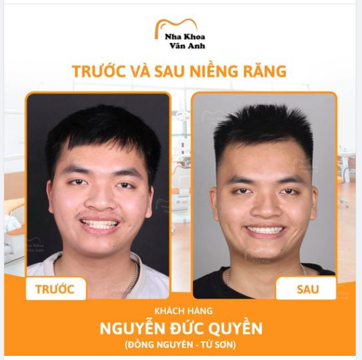 GỬI NHỮNG AI ĐANG MẶC CẢM VÌ HÀM RĂNG MÓM KÉM DUYÊN