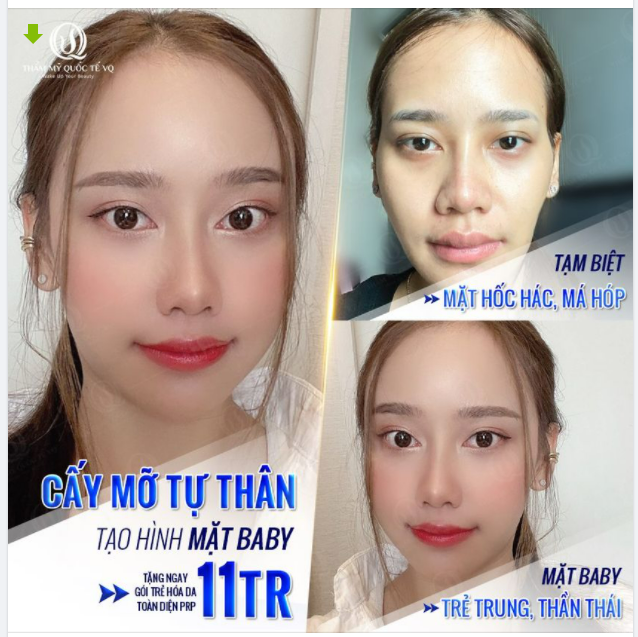 Gương mặt chưa bao giờ tươi tắn đến thế, KH như trẻ ra mấy tuổi Bác sĩ Vũ Quang đã đánh bay nỗi lo mặt hốc hác, thiếu sức sống với công nghệ cấy mỡ tự thân Stem Cells HD