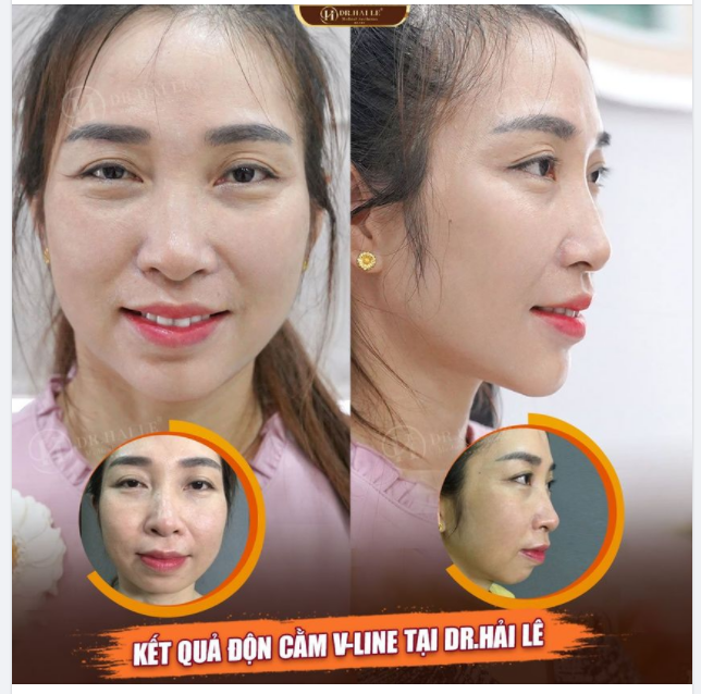 "Gương mặt thay đổi và đẹp lên rất nhiều nhưng lại chẳng ai nhận ra là mình đã thẩm mỹ"