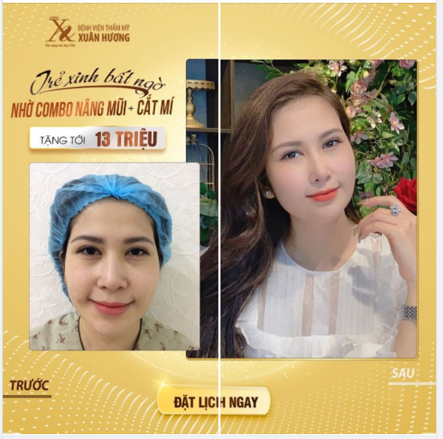 "HACK TUỔI" KHÔNG KHÓ NHỜ COMBO NÂNG MŨI + CẮT MÍ TẠI BVTM XUÂN HƯƠNG
