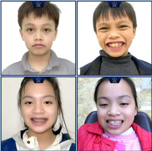 ​ Hai chị em Nguyễn Minh Đức và Nguyễn Minh Thảo đã lấy lại hàm răng đều đẹp, nụ cười tự tin, xóa bỏ hoàn toàn các khuyết điểm: Hô, Khấp khểnh, cắn ngược chỉ sau 12 tháng chỉnh nha tại Nha khoa Quốc t