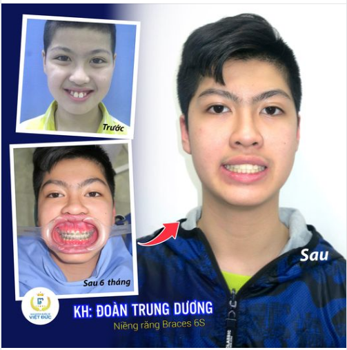 Hàm răng đều, nụ cười tươi, gương mặt nam tính sau niềng răng